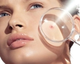 Причины появления прыщей на щеках